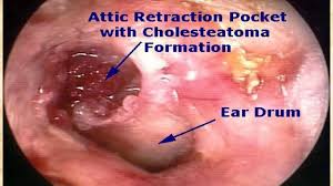 1) perforation of the tympanic membrane due to acute infection or tympanotomy tube, 2) discharge from the middle ear (otorrhea), and 3) prolonged duration (;gt;2 wk). Download Chronic Suppurative Otitis Media Ppt Slide