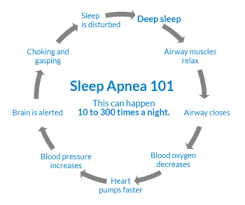 Image result for Obstructive Sleep Apnea