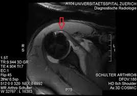 Image result for Lift-Off Subscapularis Test