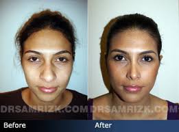 More images for nose job before and after female » Common Rhinoplasty Concerns How To Prepare For Surgery
