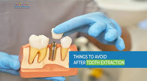 Image result for Tooth Extraction