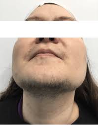Common medications prescribed as pcos treatment. Laser Hair Removal For Polycystic Ovary Syndrome The Cosmetic Clinic
