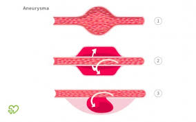 Aneurysma Symptome Ursachen Behandlung Onmeda De