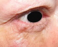 As the above pictures show, this skin cancer tends to develop on skin that has had lots of sun exposure, such as the face or ears. Malignant Melanoma Of The Eyelid Eyewiki