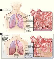 Learn more about ipf risk factors, symptoms, diagnosis. Idiopathic Pulmonary Fibrosis Wikipedia