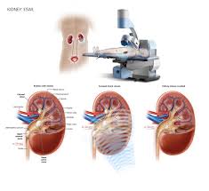Extracorporeal Shock Wave Lithotripsy Atlantic Urology Clinics