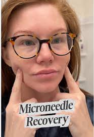 Camille Howard Microneedling