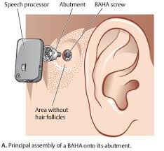 Pin On Stella Hearing