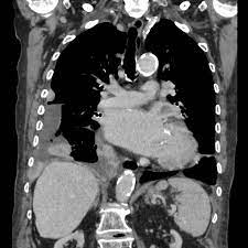 Sarcomatoid Mesothelioma Radiology Case Radiopaedia Org