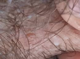 This condition is commonly referred to as barber's itch or razor bumps. What Is This Formation On My Penis Hpv Ingrown Hair Herpes Sexual Health Forums Patient