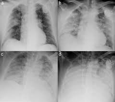 These air sacs, called alveoli, can fill with fluid or pus, causing a serious cough and fever. Multimodality Imaging Of Covid 19 Pneumonia From Diagnosis To Follow Up A Comprehensive Review European Journal Of Radiology