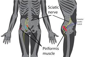 The intervertebral discs act as shock absorbers. Masalah Sciatica Punca Simptom Dan Rawatan The Diagnosa