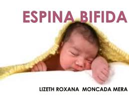Aclaración Espina Bífida