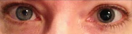 Image result for Mydriasis
