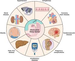 Image result for Obstructive Sleep Apnea