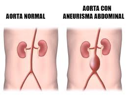 They usually cause no symptoms except when ruptured. Aneurisma Aortico Abdominal Causas Sintomas Tratamientos Y Diagnostico