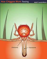 Since unlike poison ivy, it is hard to spot and avoid chiggers, it is important to learn other ways to avoid chiggers and chigger bites. Chigger Bites Howstuffworks