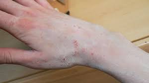 Image result for scabies effects on the human body