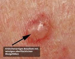 Basaliom Basalzellkarzinom Ursachen Behandlung Prognose