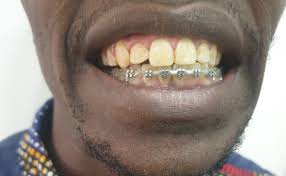 SHOULD BRACES BE DONE ON ONE JAW OR BOTH JAWS? – Ruby Smiles Dental Clinic  – Affordable Dentist In Nairobi Kenya