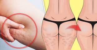 Check spelling or type a new query. Tipos De Celulitis Y Como Eliminarla Caracteristicas Soluciones