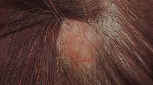 Image result for sores on the head in children