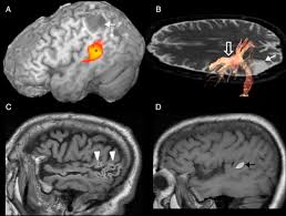 Afasia de broca, afasia de wernicke, análisis del discurso, pares adyacentes, turnos conversacionales, marcadores discursivos. Correlacion Neurorradiologica De Las Afasias Mapa Cortico Subcortical Del Lenguaje Sciencedirect