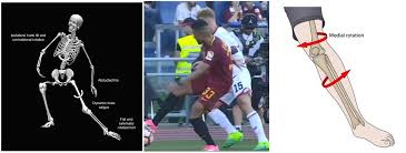 Lesão do Ligamento Cruzado Anterior - LCA em Porto Alegre - Dr. Leonardo  Rocha Thomaz