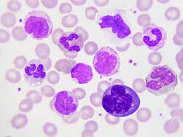 Human blood on microscope slide. White Blood Cells In In Blood Smear Analyze By Microscope Stock Photo Picture And Royalty Free Image Image 82736609