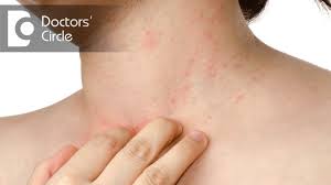 I always had fairly clear skin, but ever since i star. How To Manage Pimples Present In Neck Region Dr Rashmi Ravindra Youtube