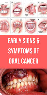 This can be true also of feline oral cancer (cat mouth cancer). Early Signs Of Mouth Cancer In Cats Know The Early Signs And Symptoms Of Mouth Cancer Blog Difficulty In Breathing Can So Early Detection And Treatment Are Very Important