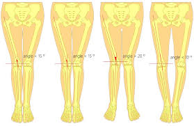 Image result for Functional Leg Length Discrepancy