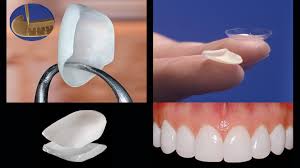 Know how porcelain veneers can help to improve the look of your teeth. Porcelain Veneers Beverly Hills Dental Veneers Los Angeles Cosmetic Veneers Century City Best Dentist Beverly Hills