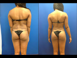 Pin By Body Sculpture Centers Of Flor On Liposuction Before And Afters Mommy Makeover Liposuction Anti Aging Health