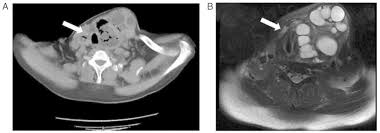 Gharbi classification pure fluid collection. Hydatid Cyst Of The Thyroid Gland With Tracheal Fistula A Case Report And Review Of The Literature