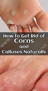 Get Rid Of Corns Forever Remedies Get Rid Of Corns Corn On Toe Toe Corn Removal