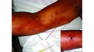 Image result for Nodular Lymphangitis