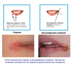 заеды в уголках рта причины и лечение у взрослых Zaedy V Ugolkah Lechenie V Domashnih Usloviyah Zaedy Na Gubah