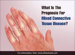 What Is The Treatment For Mixed Connective Tissue Disorder