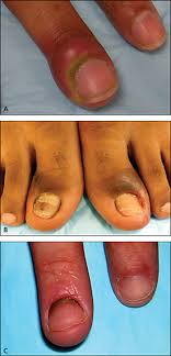 With a metal cuticle pusher, gently push the polish off your nails, pushing from your cuticles downward. Evaluation Of Nail Abnormalities American Family Physician