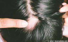 Some types cause temporary hair loss and your hair will grow back. Alopecia Areata Auf Dauer Steigt Das Infarkt Risiko Gelbe Liste