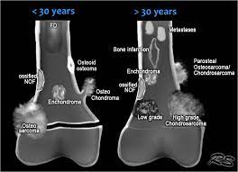The Radiology Assistant Sclerotic Tumors