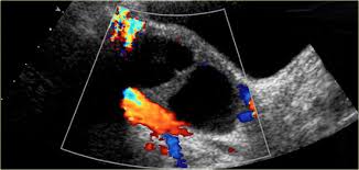 Cancer is a disease in which some of the body's cells begin to divide without stopping, and spread into surrounding tissue. The Radiology Assistant Roadmap To Evaluate Ovarian Cysts