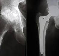 Reemplazo total de cadera (Total Hip Replacement ...