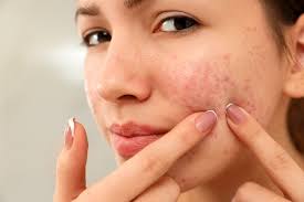 When it is made into a paste and applied onto the face, the baking soda exfoliates your skin to minimize annoying acne scars. 10 Home Remedies To Get Rid Of Redness On Face Beautymed Richmond Hill