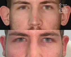 Incision Otoplasty Ear Pinning No Surgery Aspen Facial Plastics SLC|UT  Before After #otoplasty, Also