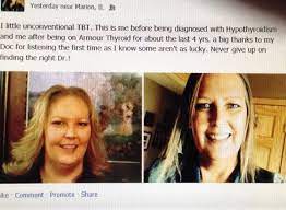 250 mg, 500 mg, 750 mg; This Is Michelle Before Being Diagnosed With Hypothyroidism And After Being On Armour Thyroid She Feel Better Than She Healthy Thyroid Thyroid Hypothyroidism