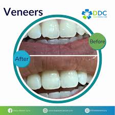 Veneer gigi cocok untuk kamu yang ingin puri dental clinic memberikan harga rp 1.5jt 500ribu/gigi untuk veneer direct. Layanan Diana Dental Care