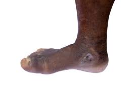 Image result for toe black diabetes