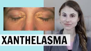 Image result for xanthelasma of eyelid